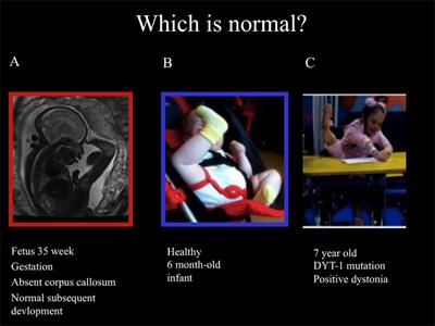 Recognizing the Common Origins of Dystonia and the Development of Human Movement: A Manifesto of Unmet Needs in Isolated Childhood Dystonias